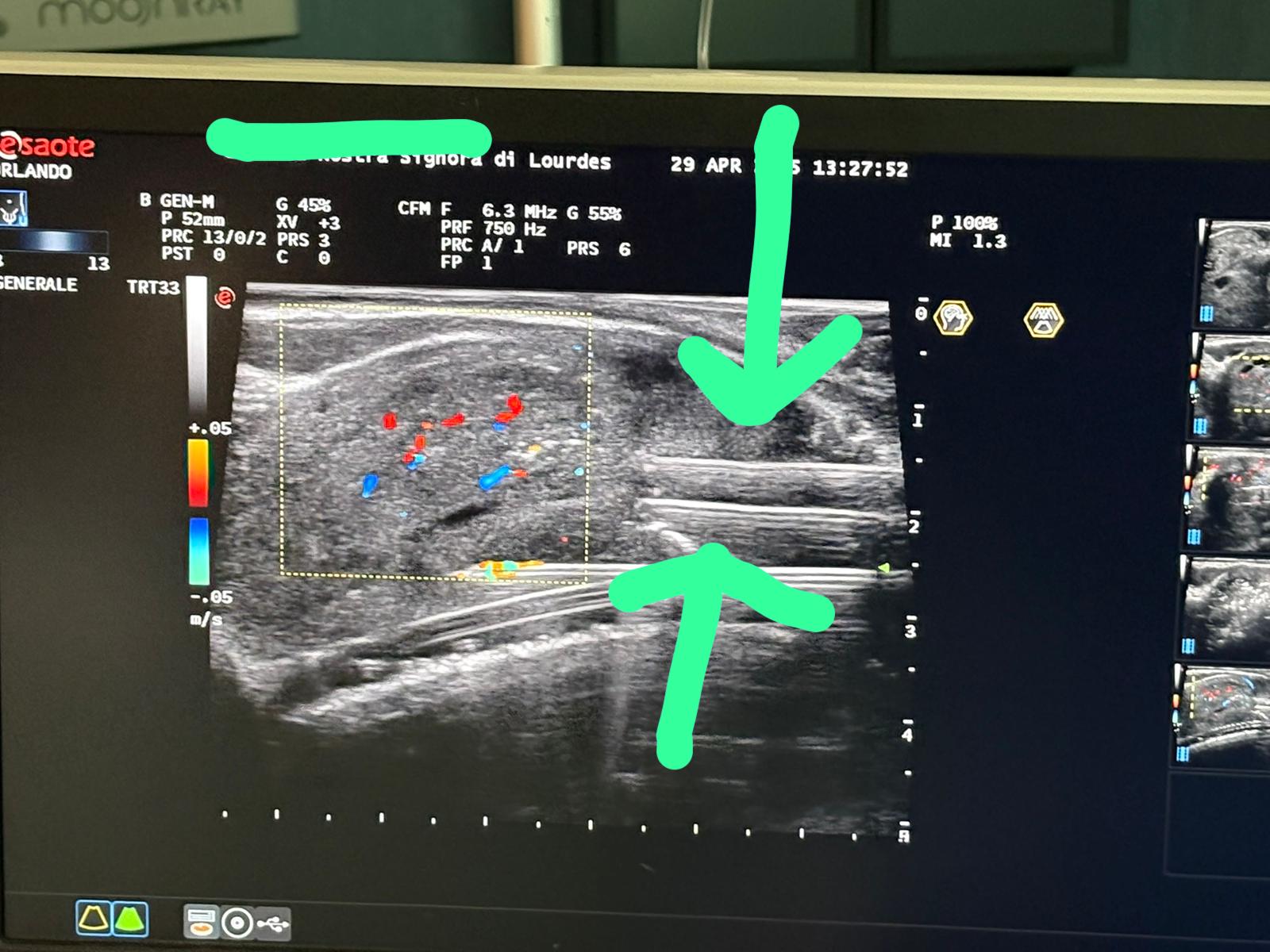 Aghi TPLA - Terapia Laser Percutanea